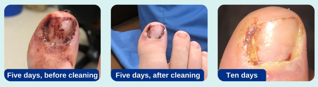 Photographs of a toe in the early stages of healing after nail surgery