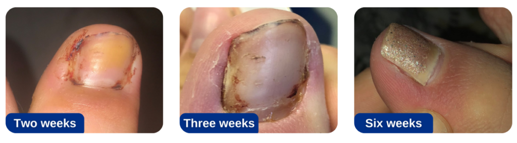 Photograph of a toe in the later stages of healing after nail surgery