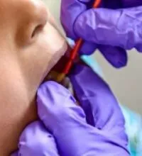 A photograph of a child receiving fluoride varnish on their teeth