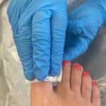 Photo - cleaning toe after removing old dressing