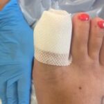 Photograph - toe with new dressing